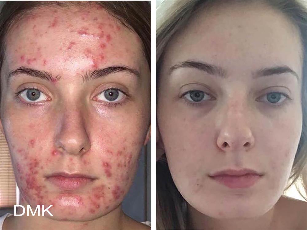 DMK Treatment - Acne Before and After